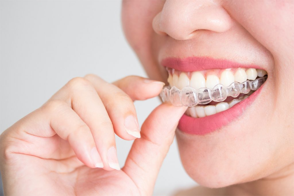 What to Look For In an Invisalign Treatment